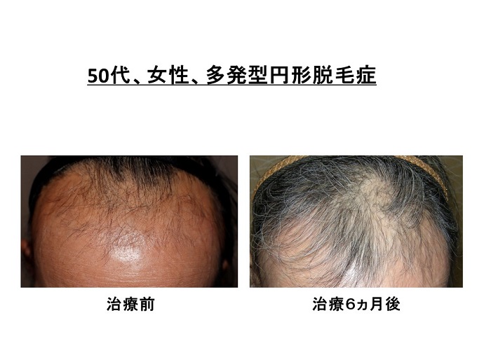 円形脱毛症　病院